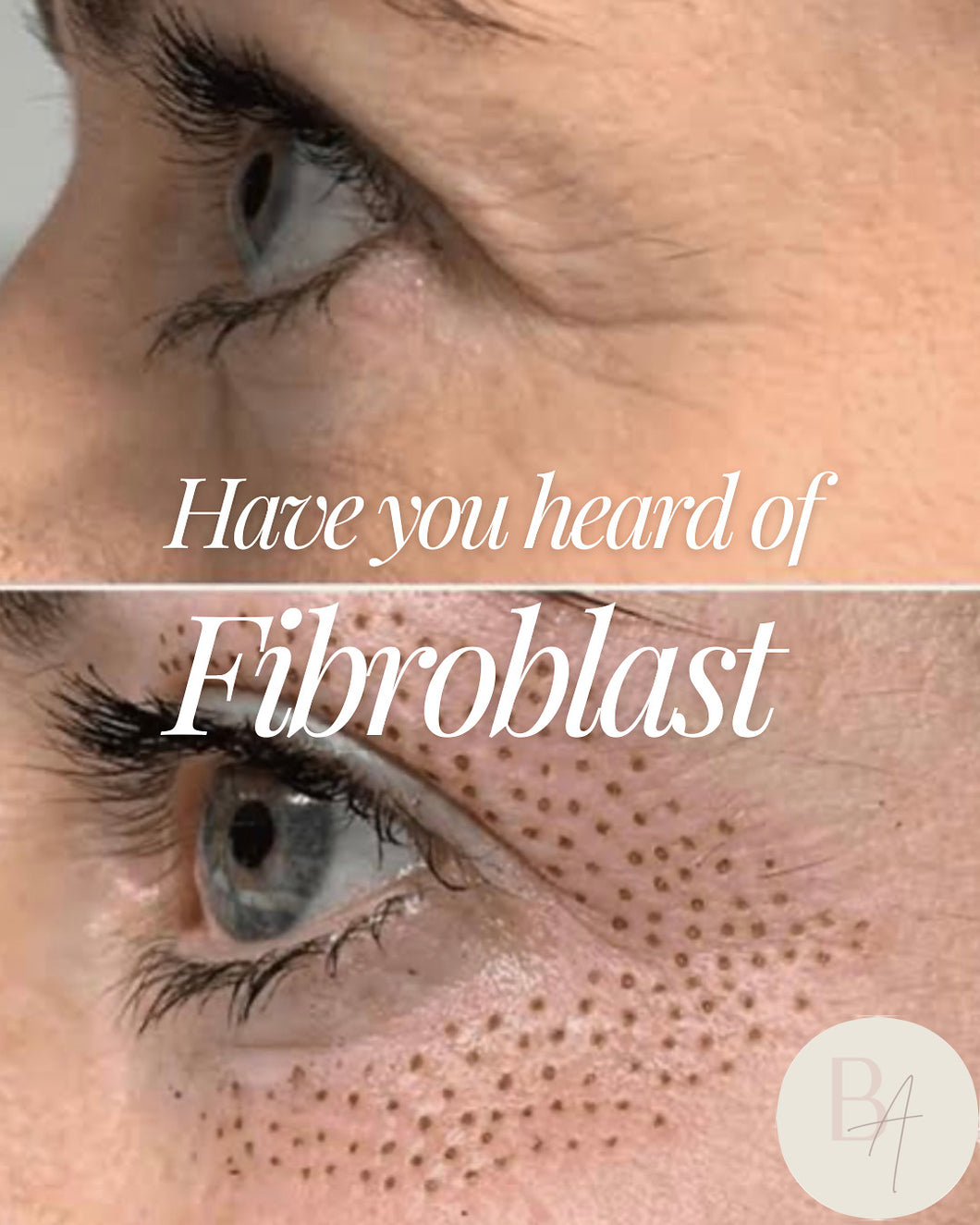 Fibroblast eyelids only