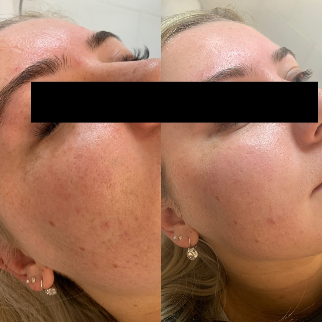 Skin needling