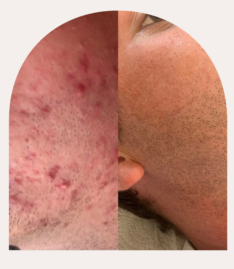 Laser Acne Treatment 6 sessions